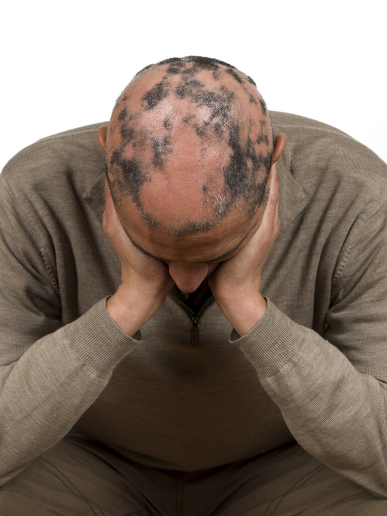 EU godkänner Abbvies behandling mot svår alopecia areata